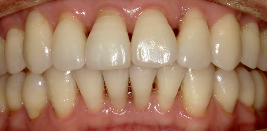 Bioclear Black Triangle treatment in Austin at Austin City Dental