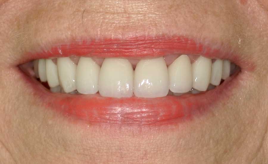 Veneers in Austin at Austin City Dental before and after