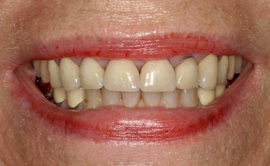Veneers in Austin at Austin City Dental before and after