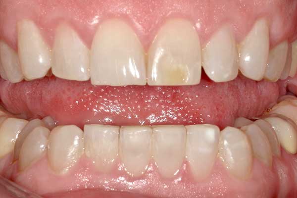 Veneers in Austin at Austin City Dental Before Picture