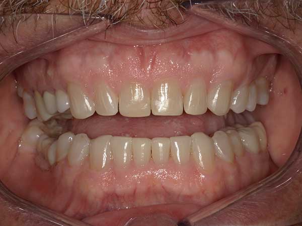 Dental Bonding in Austin After Picture