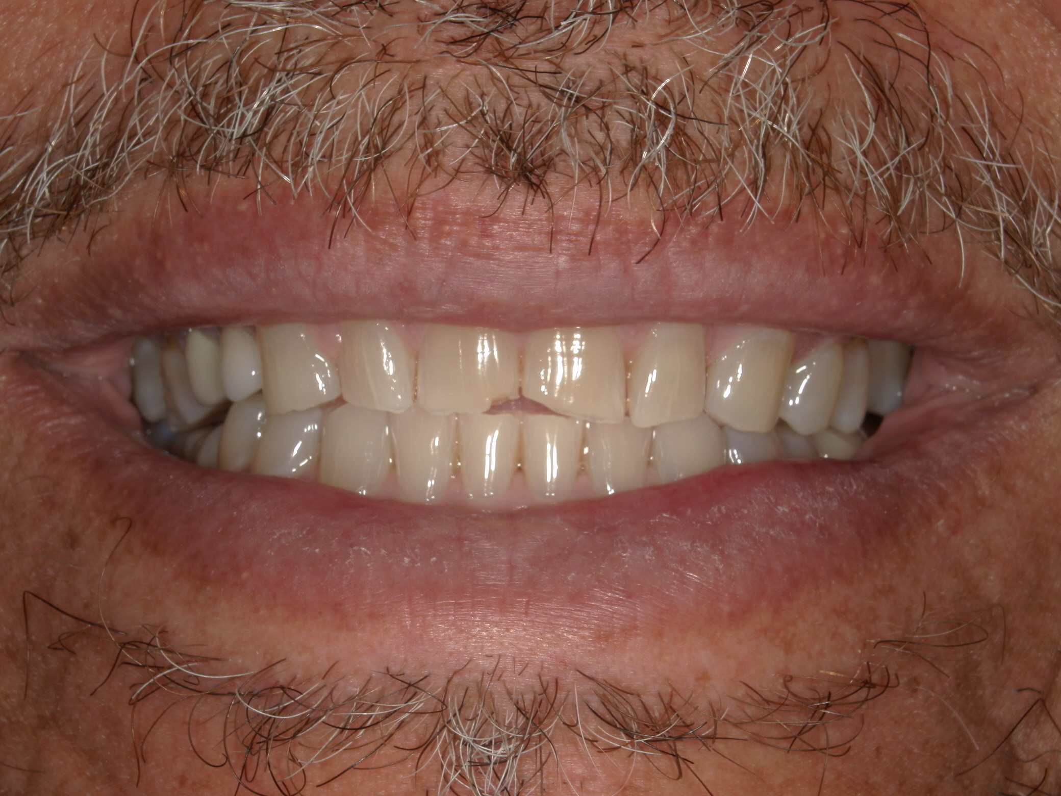 Austin Smile Before and After Gallery Before Picture