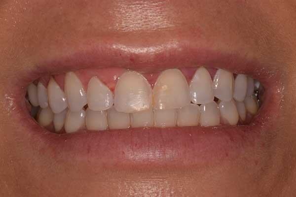 Veneers in Austin at Austin City Dental Before Picture