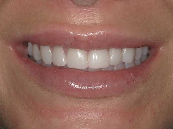 Veneers in Austin at Austin City Dental After Picture