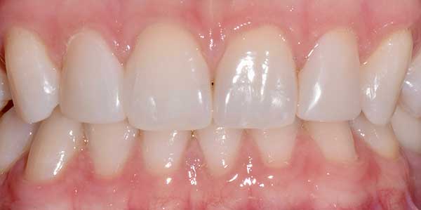 Dental Bonding in Austin at Austin City Dental After Picture