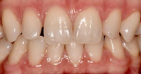 Dental Bonding in Austin at Austin City Dental Before Picture