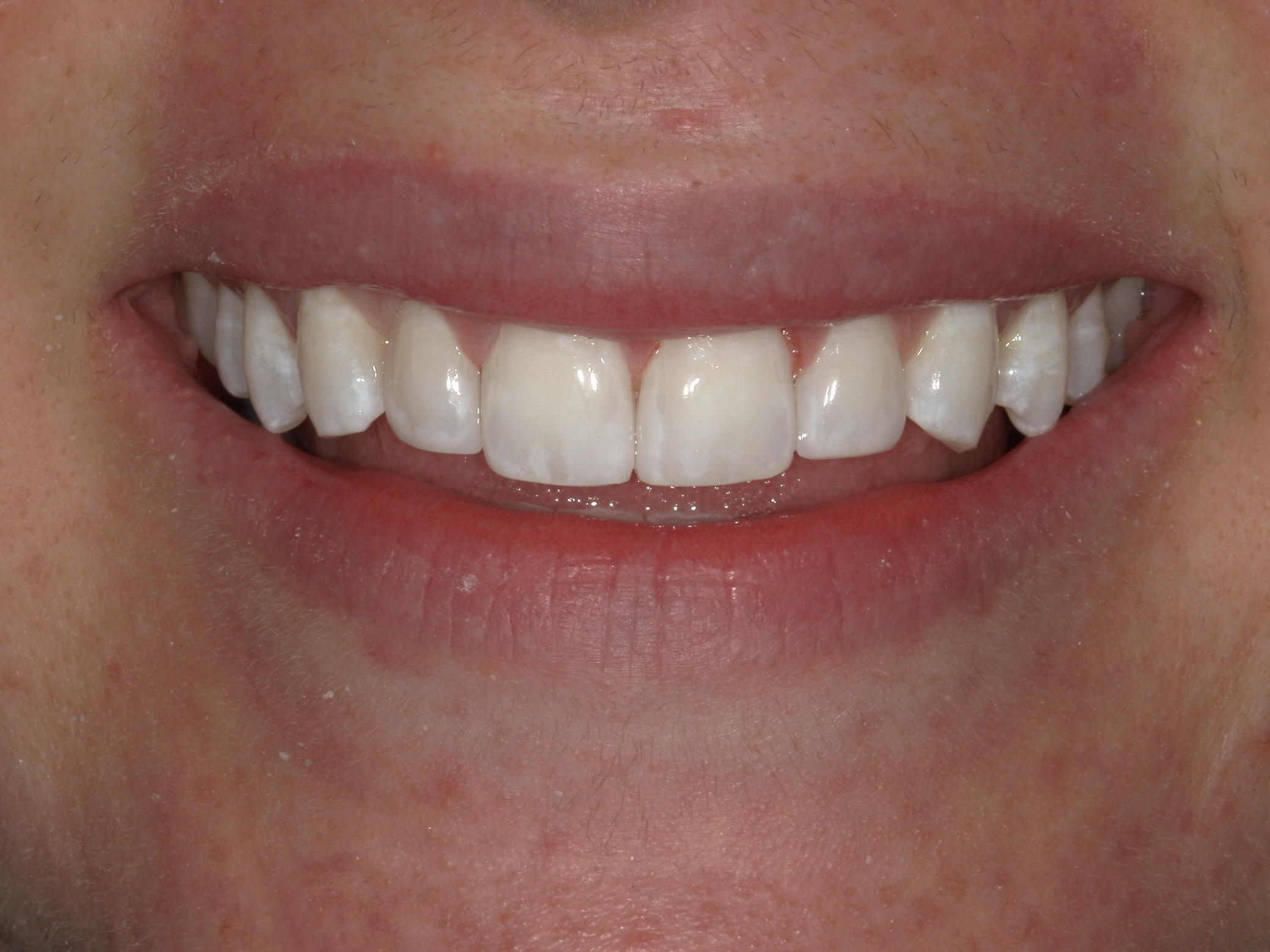 Bioclear in Austin at Austin City Dental After Picture