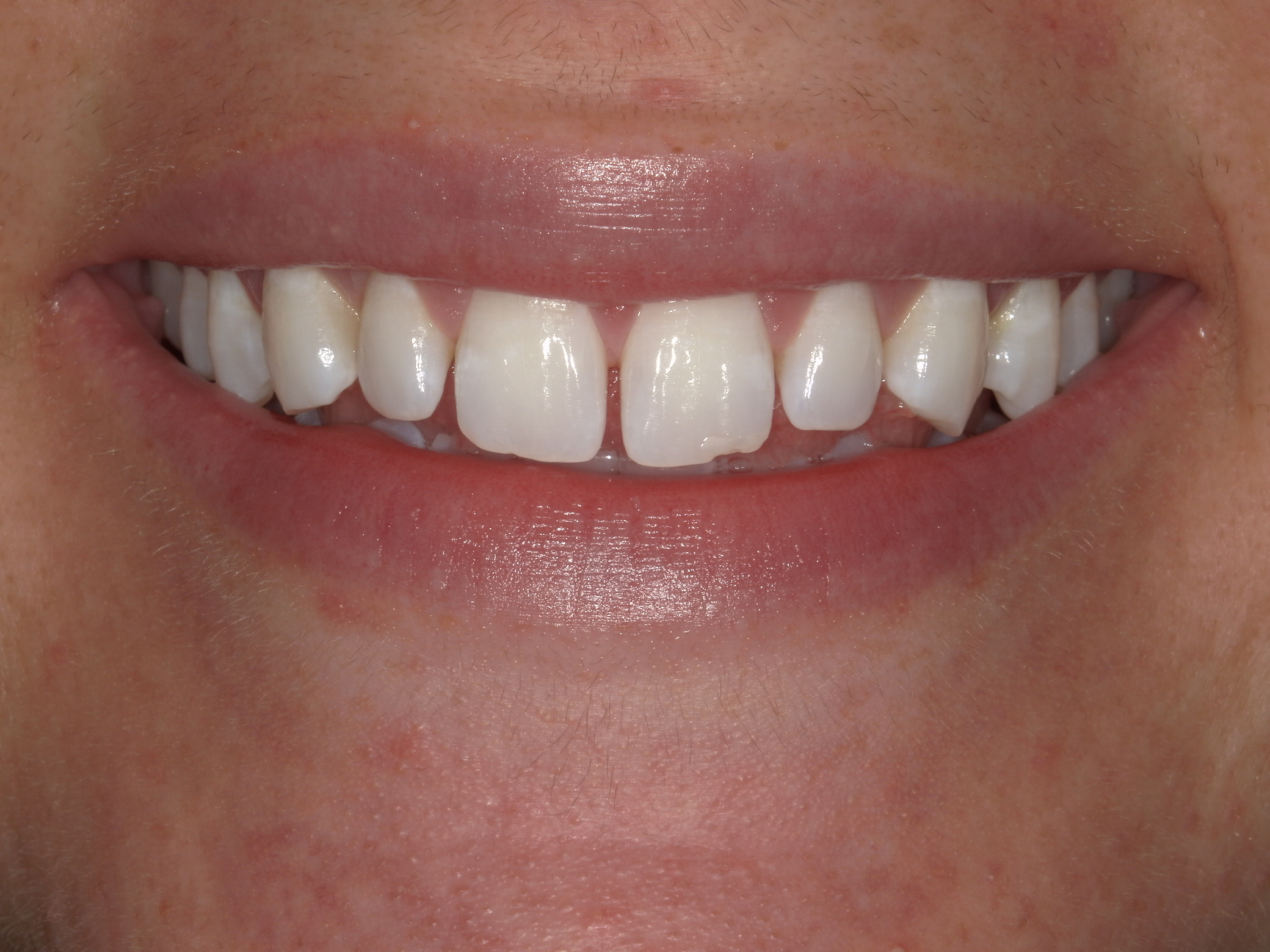 Bioclear in Austin at Austin City Dental Before Picture