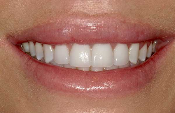 Veneers in Austin at Austin City Dental After Picture