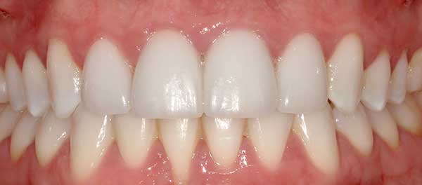 Veneers in Austin at Austin City Dental After Picture