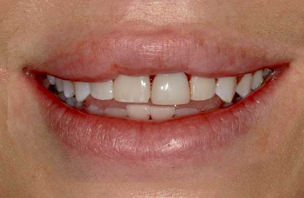 Austin Smile Before and After Gallery at Austin City Dental Before Picture