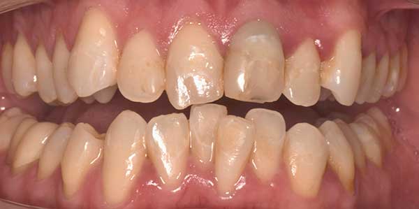 Invisalign in Austin at Austin City Dental Before Picture