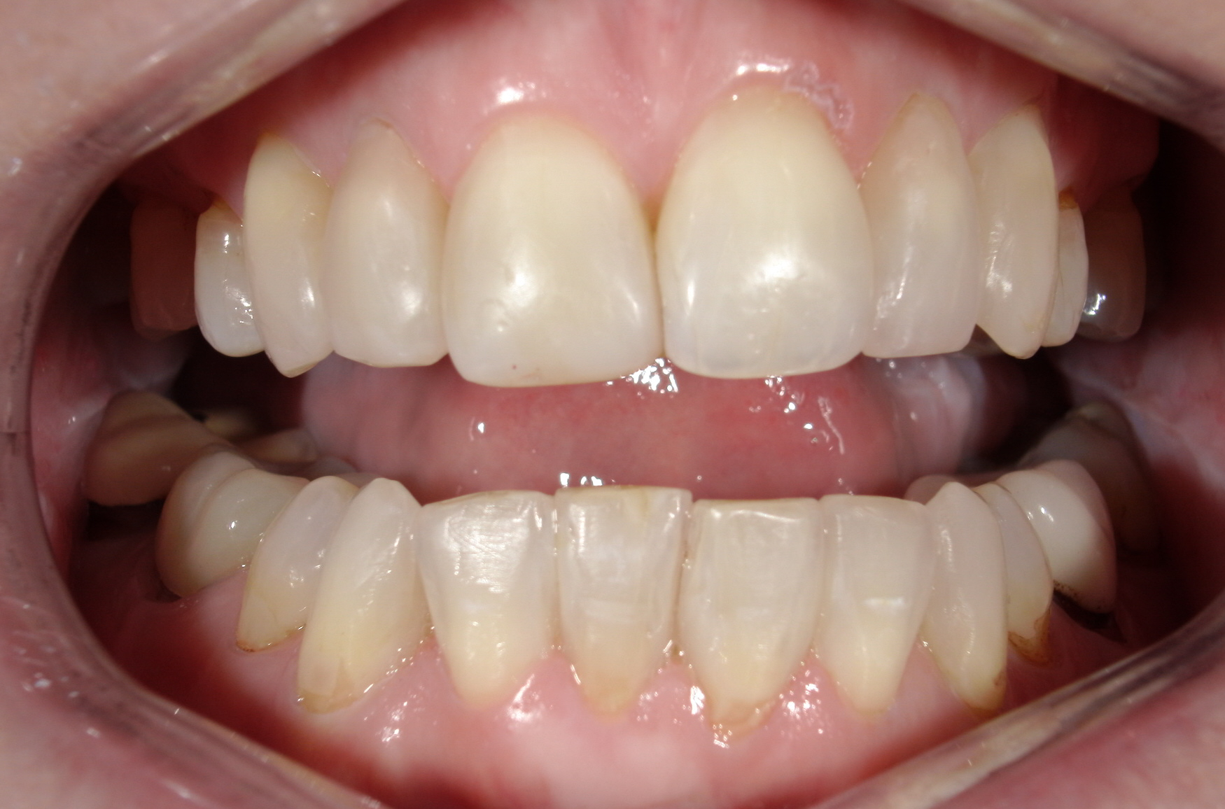 Bioclear in Austin at Austin City Dental After Picture