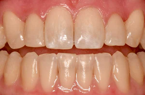 Bioclear in Austin at Austin City Dental After Picture
