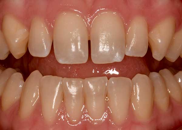 Bioclear in Austin at Austin City Dental Before Picture