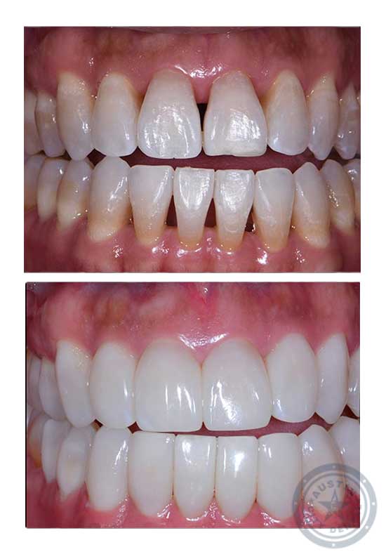 Bioclear black triangle closure treatment in Austin TX at Austin City Dental