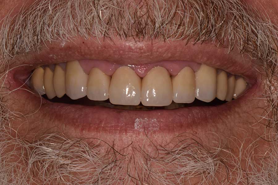 Before and After Dental Crowns in Austin at Austin City Dental - After