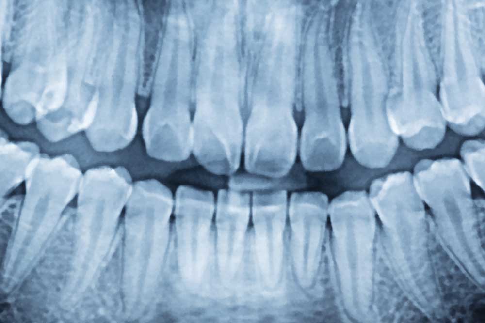 Digital X Rays Austin Texas Austin City Dental