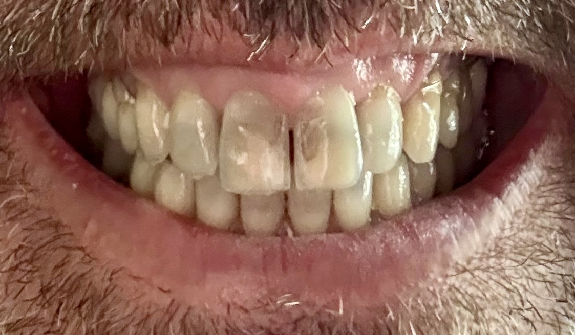 Dental Bonding Case 5, before photo