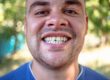 How to Fix a Chipped Front Tooth in Austin