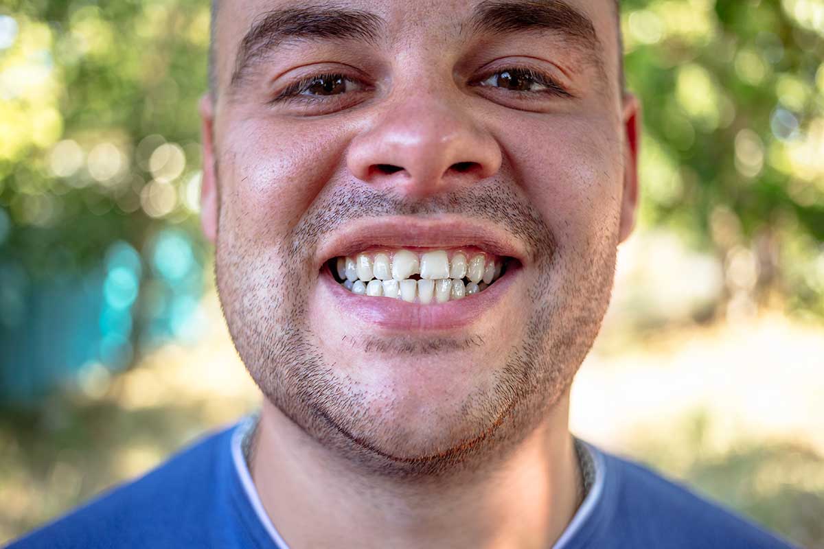 Chipped front tooth example in Austin