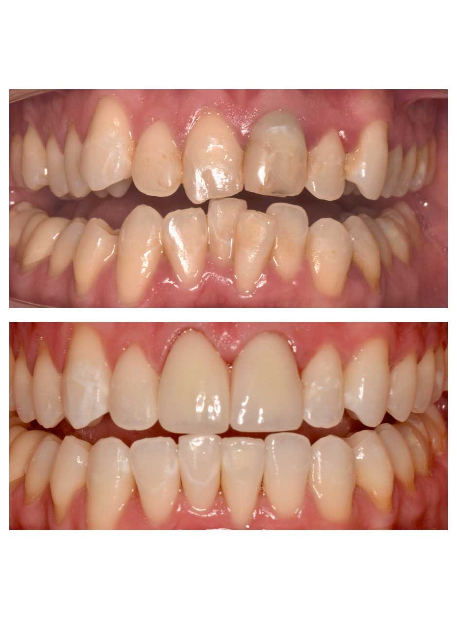 Invisalign treatment before and after case 1