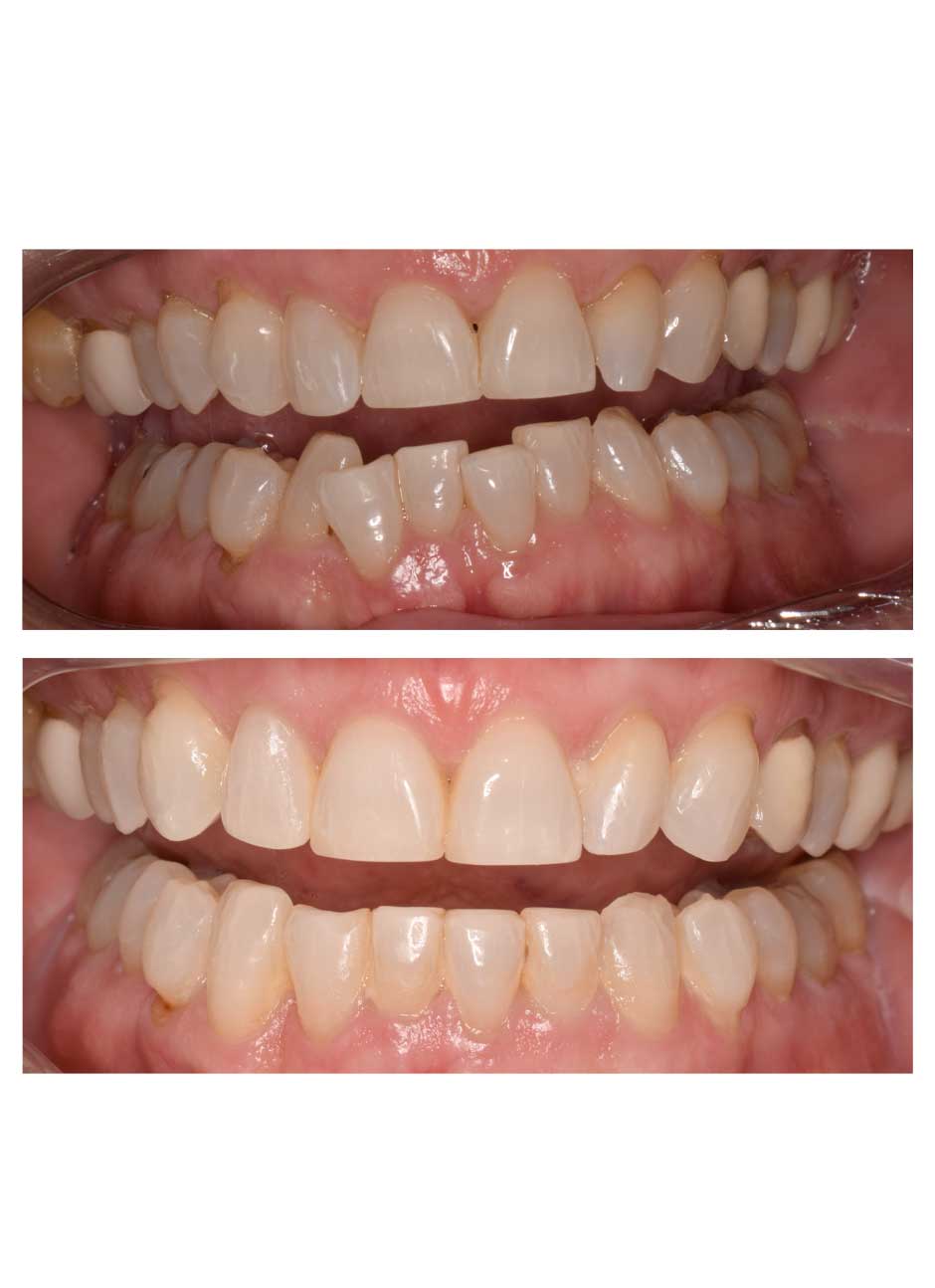 Invisalign treatment before and after case 2