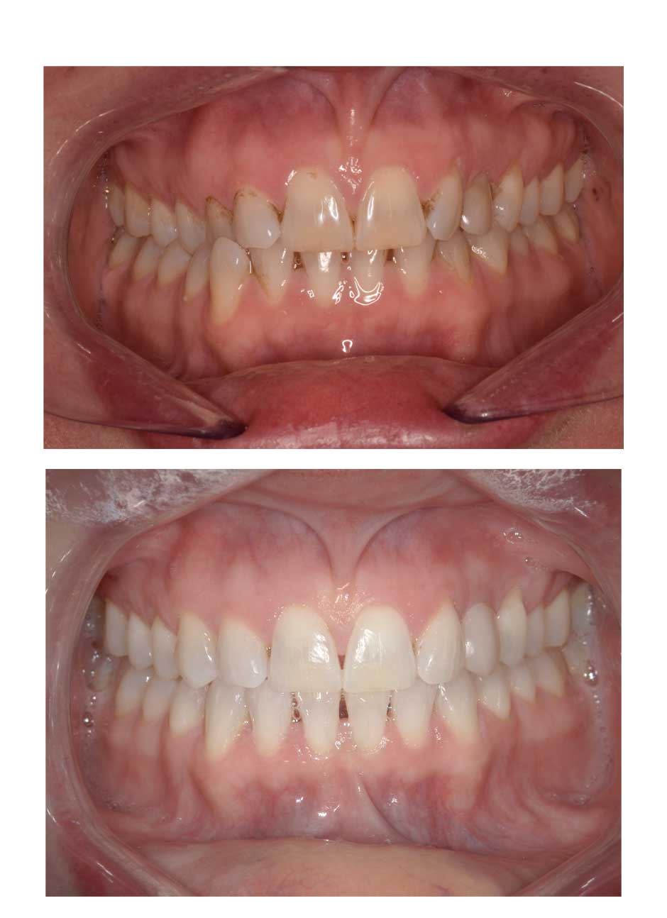 Invisalign treatment before and after case 3