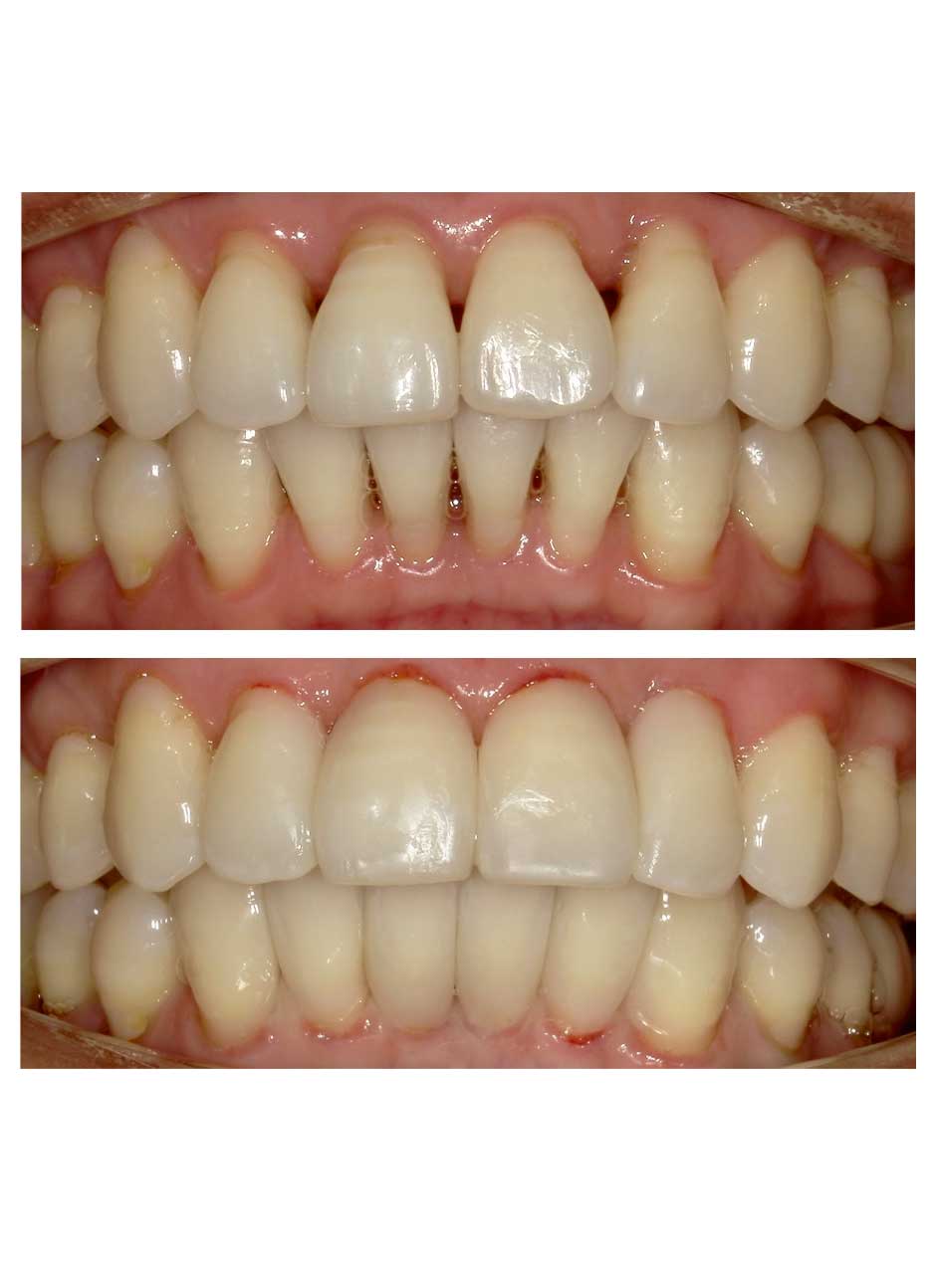 Bioclear black triangle treatment case 1-2 before and after