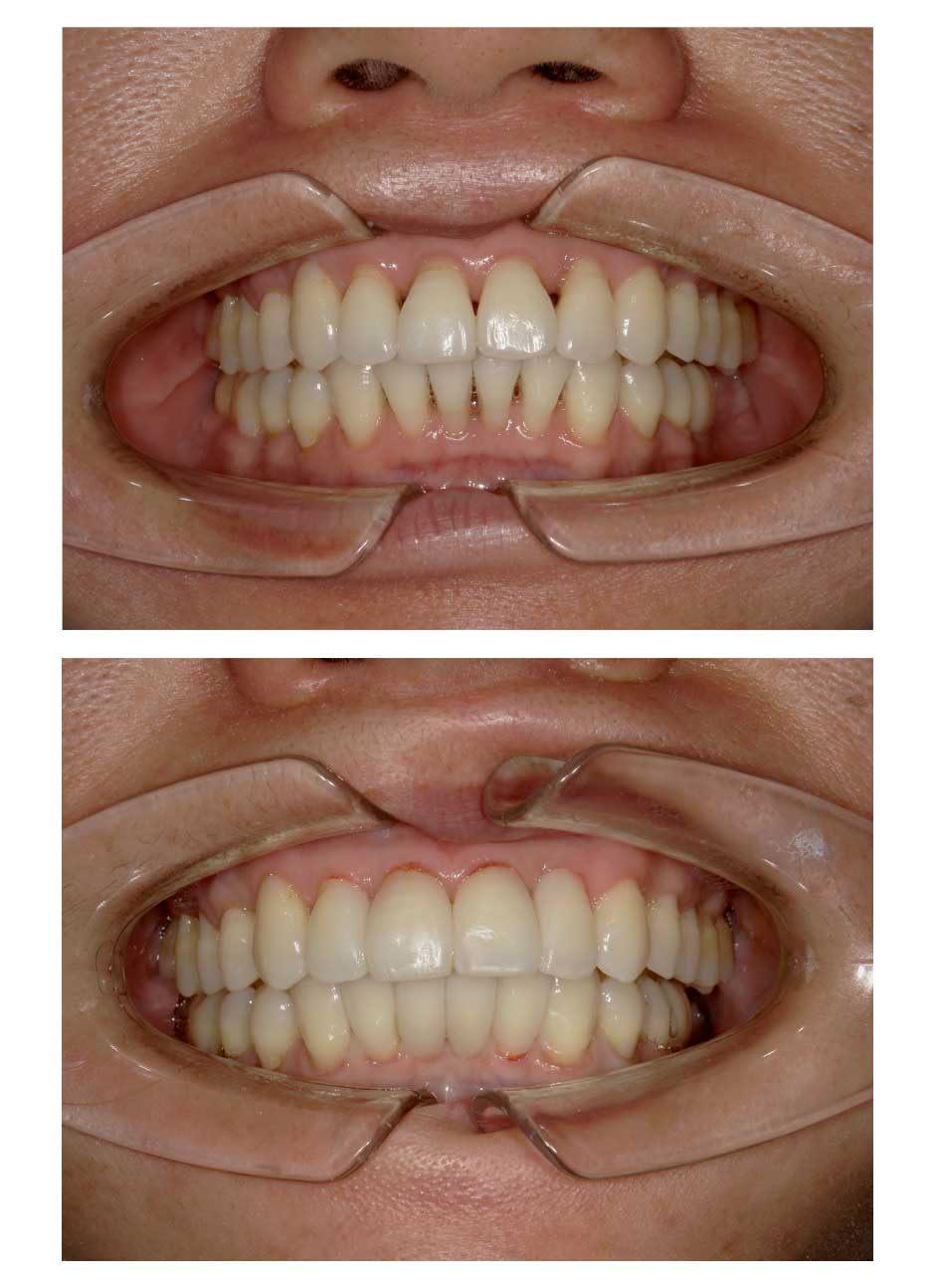 Bioclear black triangle treatment case 1 before and after
