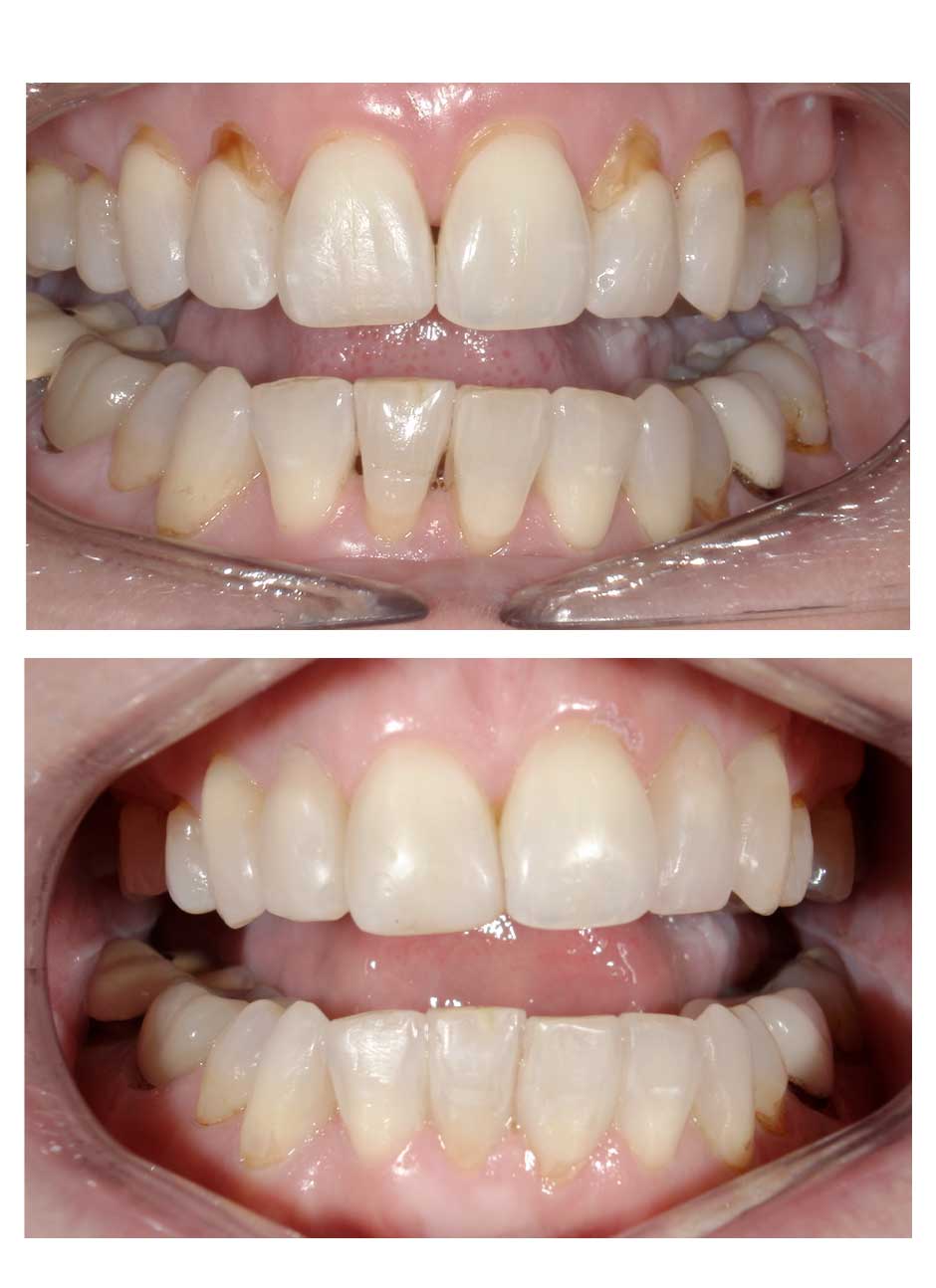 Bioclear black triangle treatment case 2 before and after
