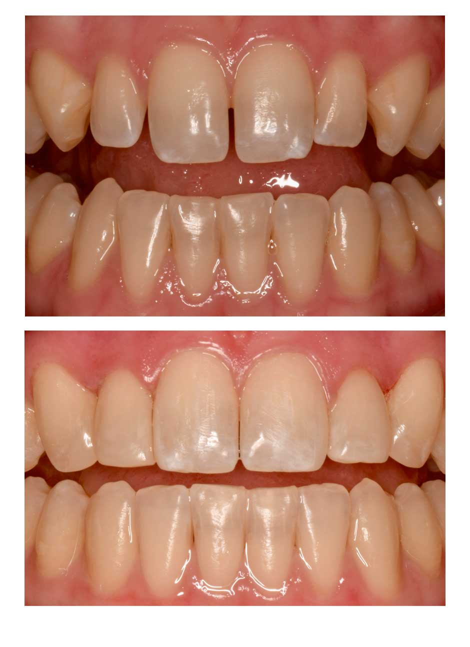Bioclear black triangle treatment case 3 before and after
