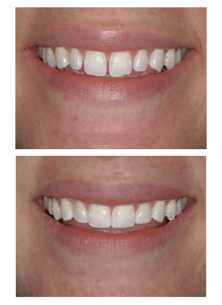 Bioclear black triangle treatment case 4 before and after