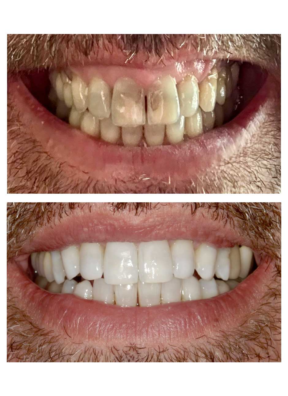 Dental bonding case 3-1 before and after at Austin City Dental