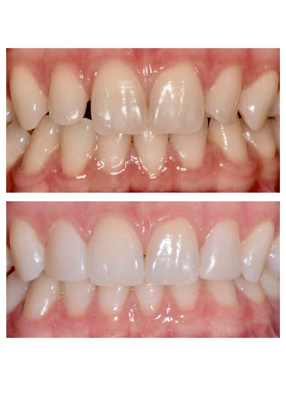 Dental bonding case 3 before and after at Austin City Dental