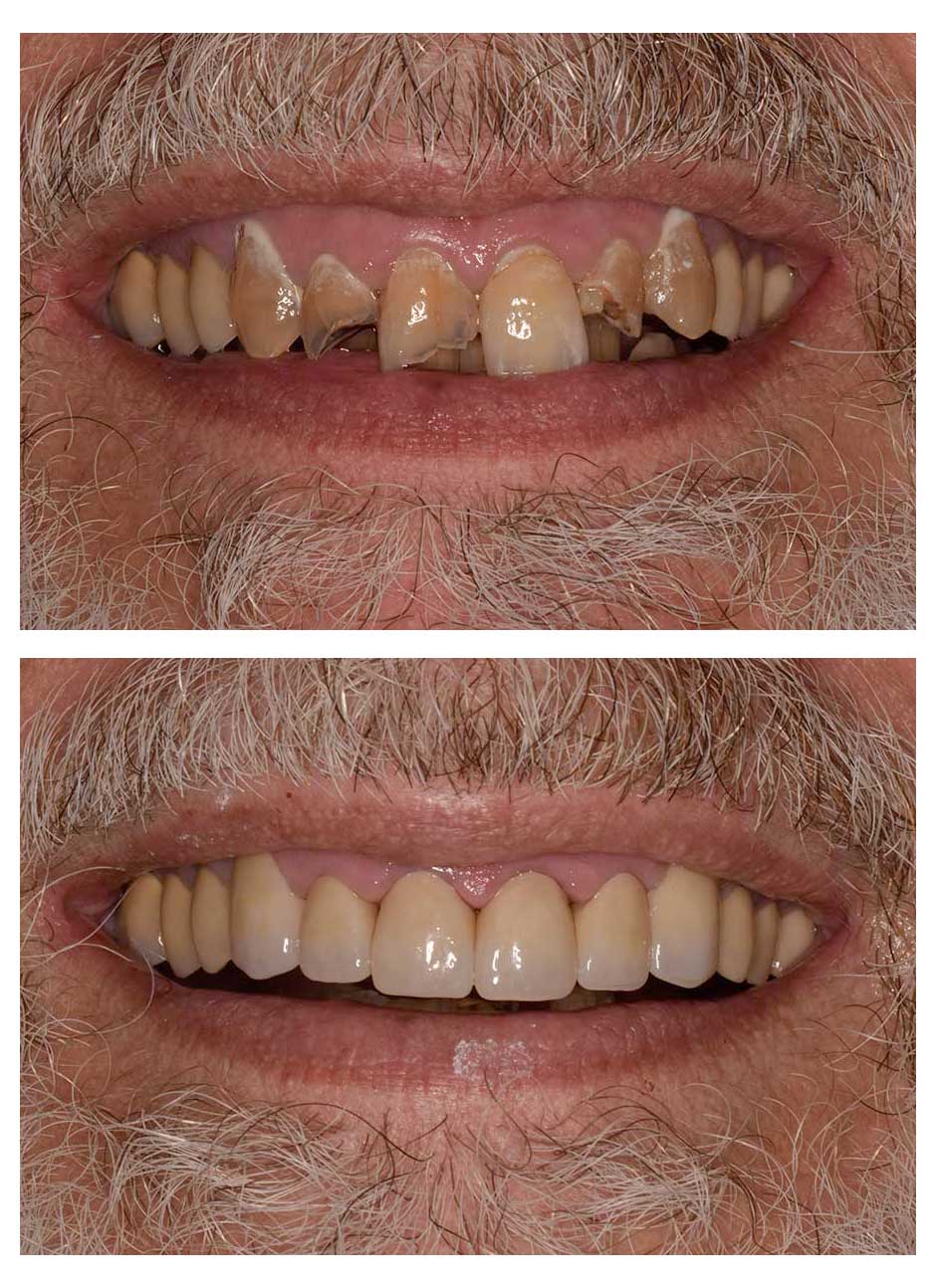 Crowns Case 1 before and after at Austin City Dental