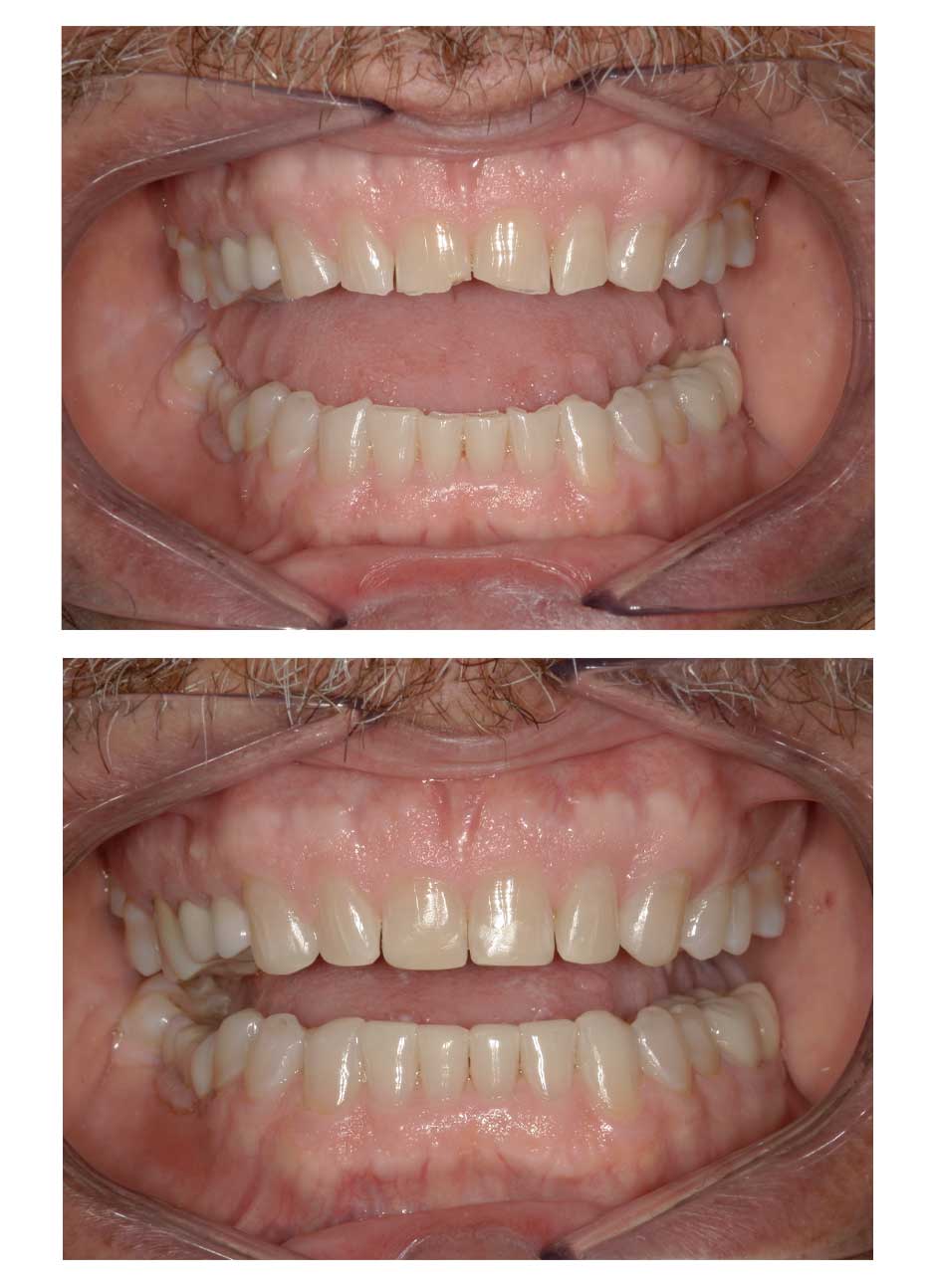 Dental bonding case 1-2 before and after at Austin City Dental