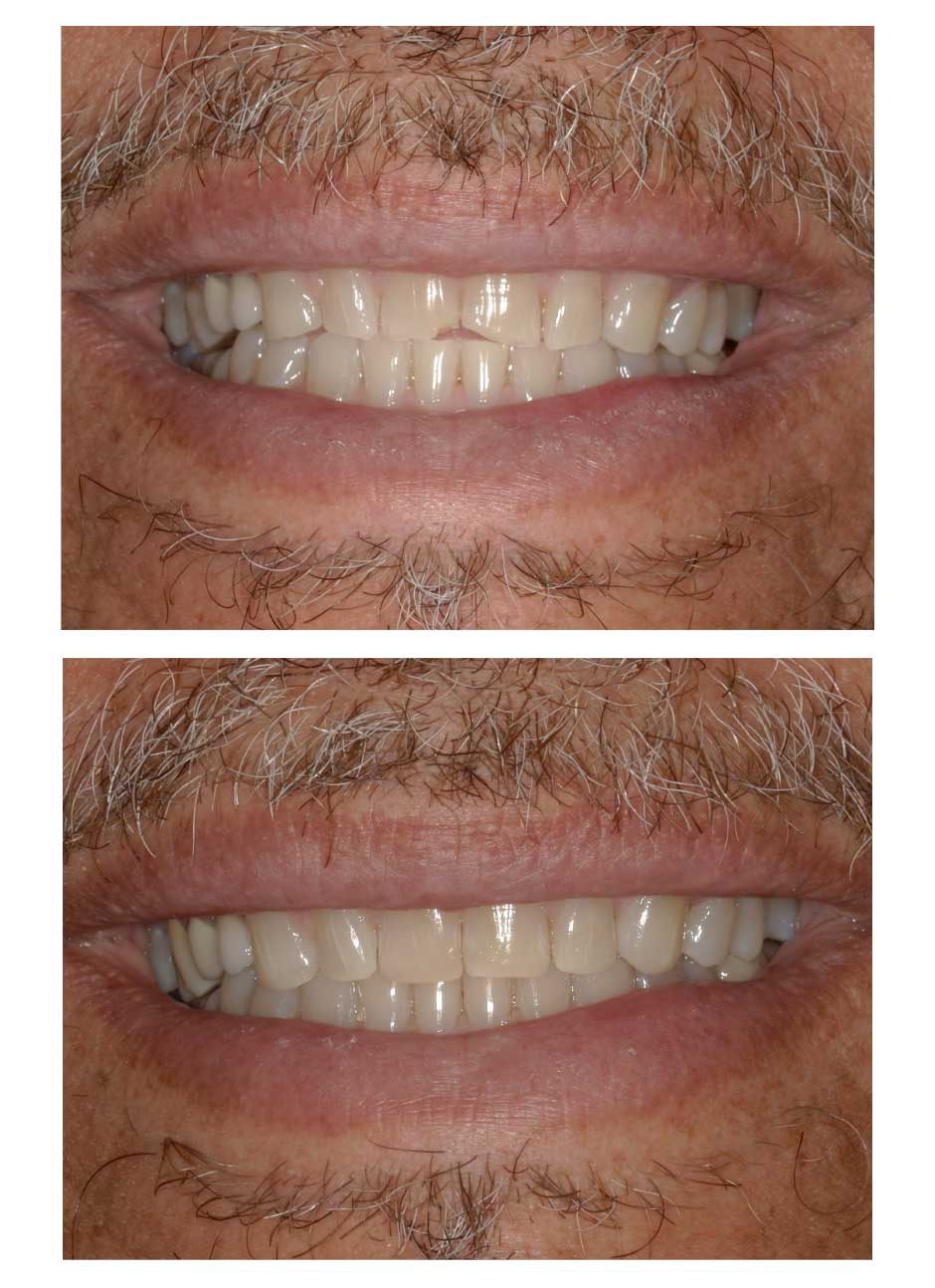 Dental bonding case 1 before and after at Austin City Dental