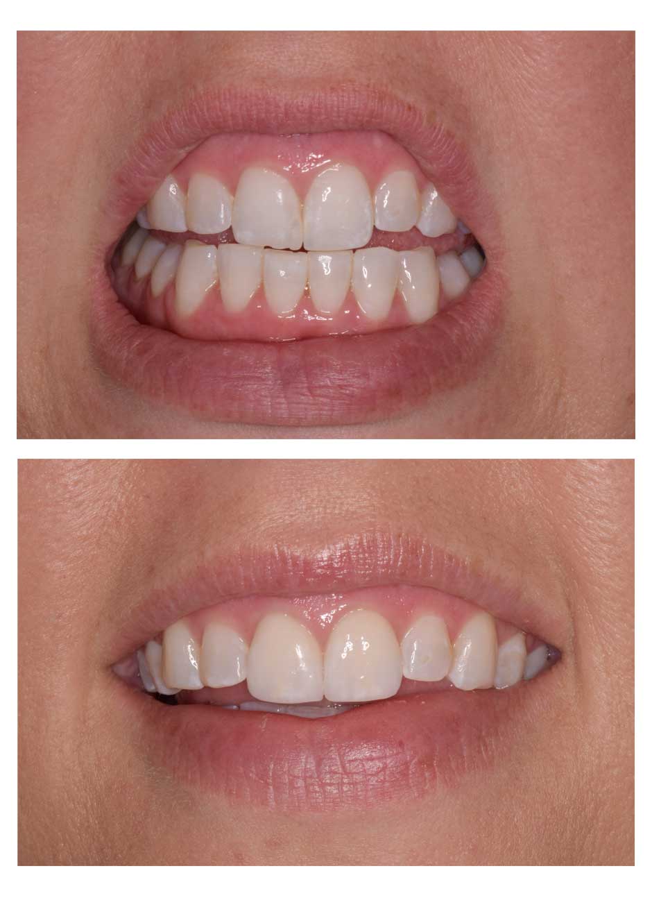 Dental bonding case 2 before and after at Austin City Dental