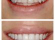 Good candidate for veneers consultation in Austin