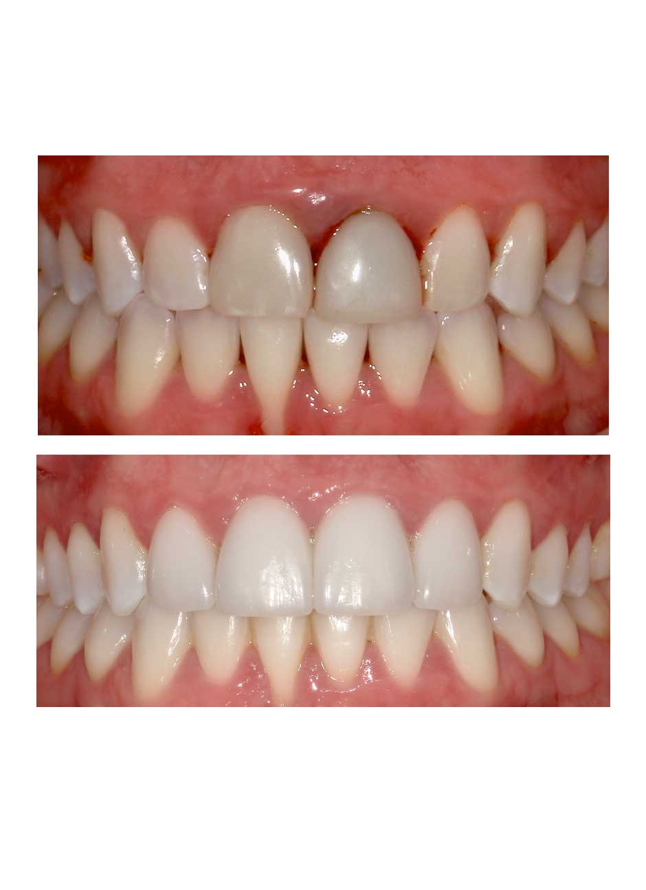 Veneers Case 1-2 before and after at Austin City Dental