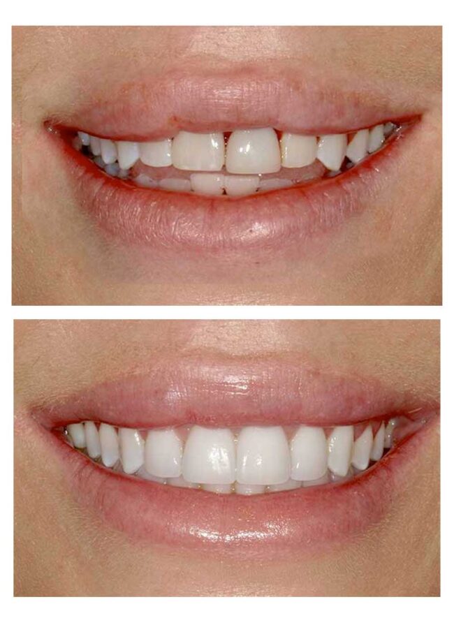 Good candidate for veneers consultation in Austin