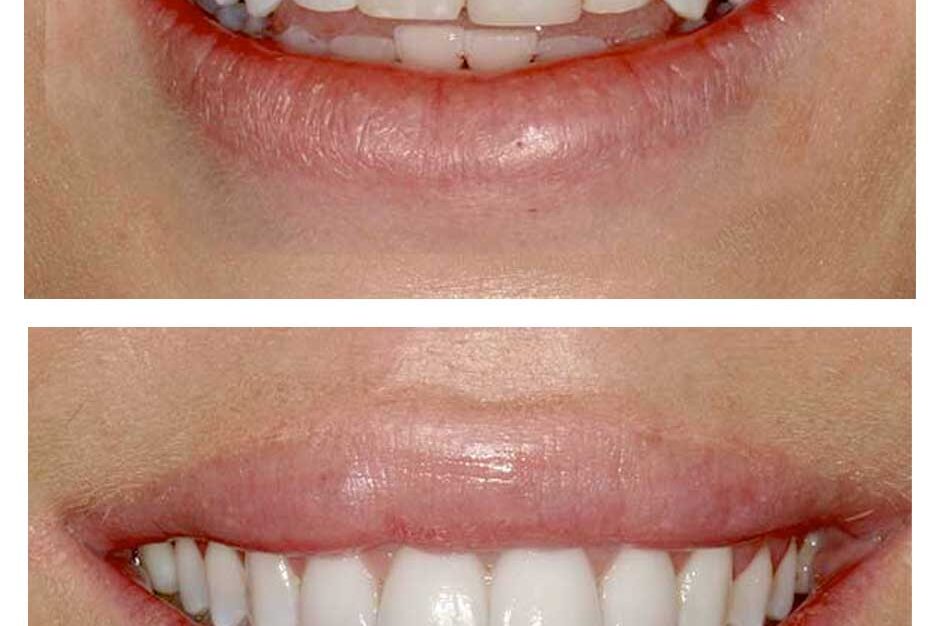 Good candidate for veneers consultation in Austin