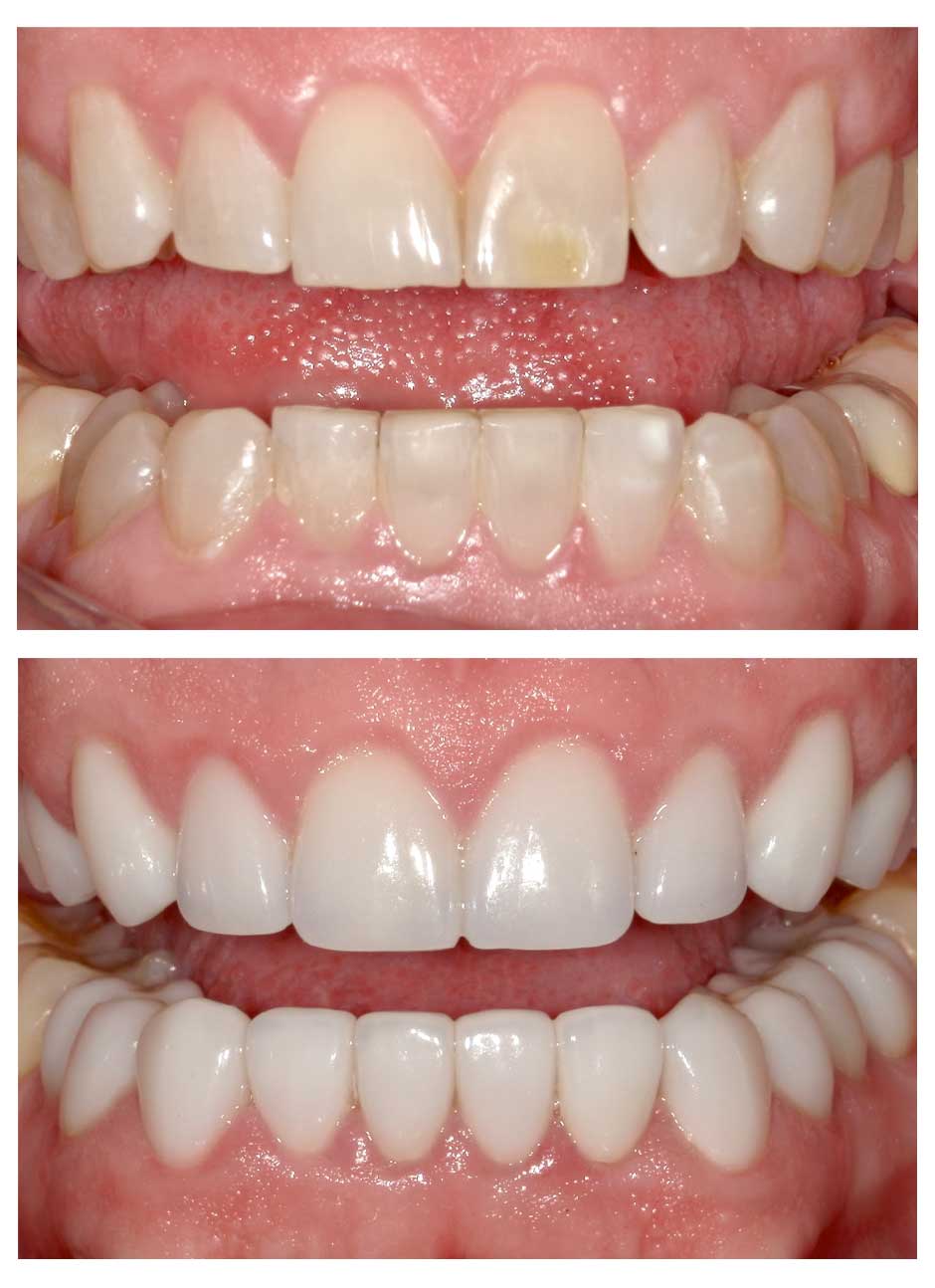 Veneers Case 2 before and after at Austin City Dental