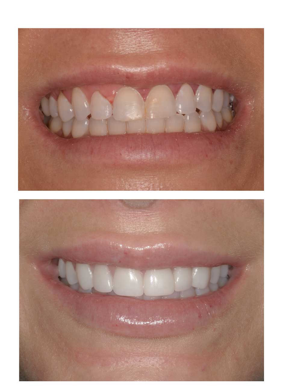 Veneers Case 3 before and after at Austin City Dental