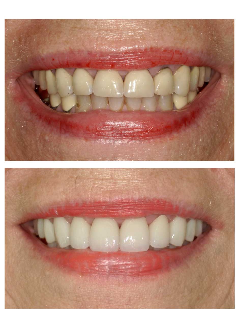 Veneers Case 4 before and after at Austin City Dental