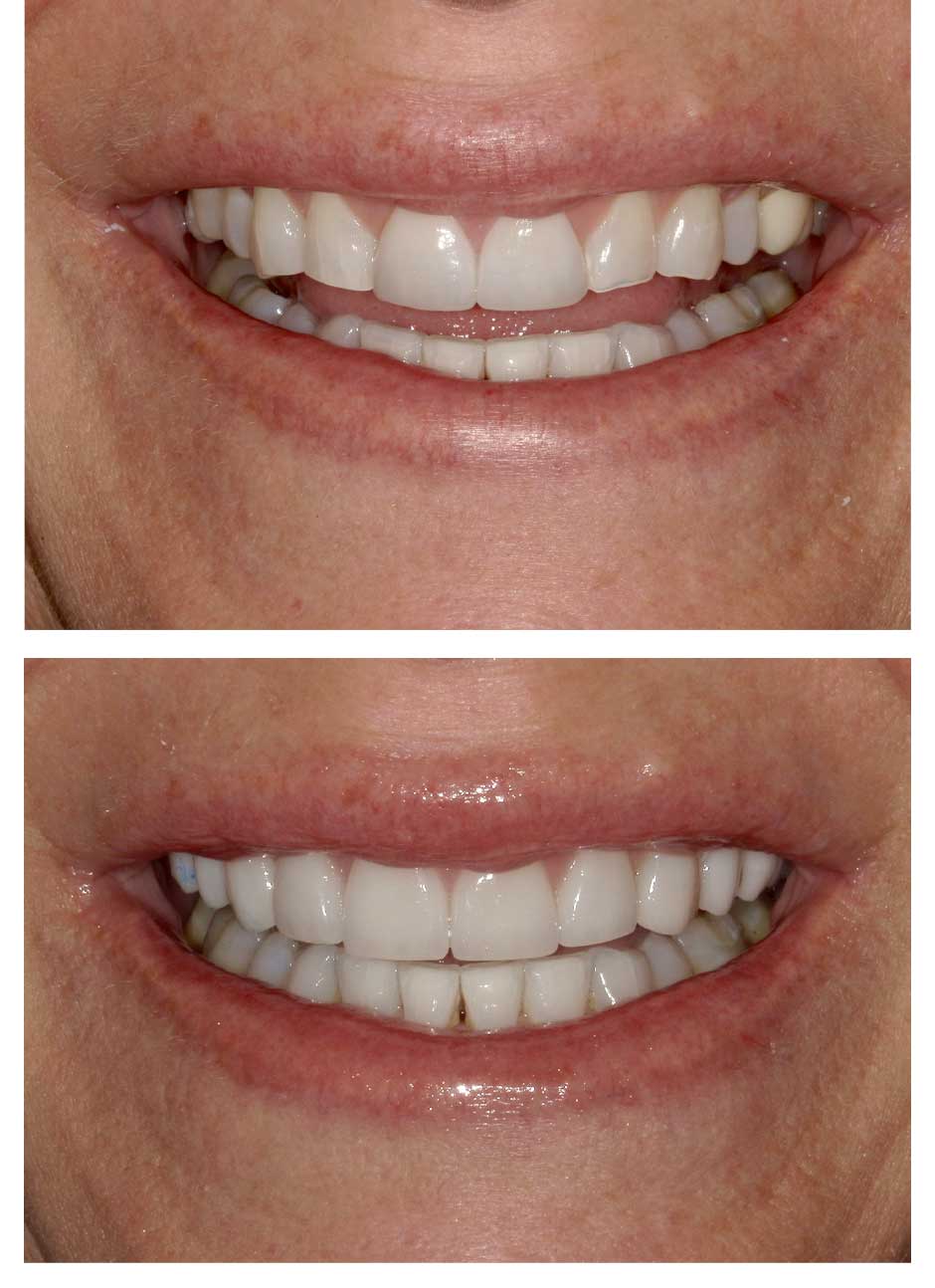 Veneers Case 5 before and after at Austin City Dental