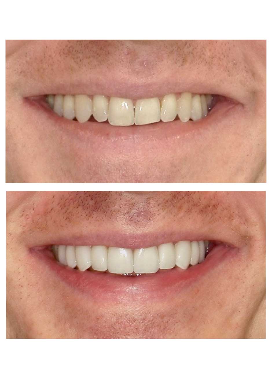 Veneers Case 6 before and after at Austin City Dental