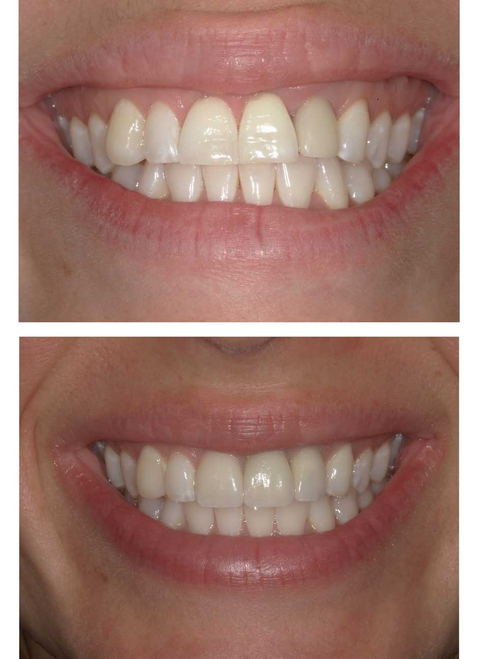 Veneers Case 7 before and after at Austin City Dental