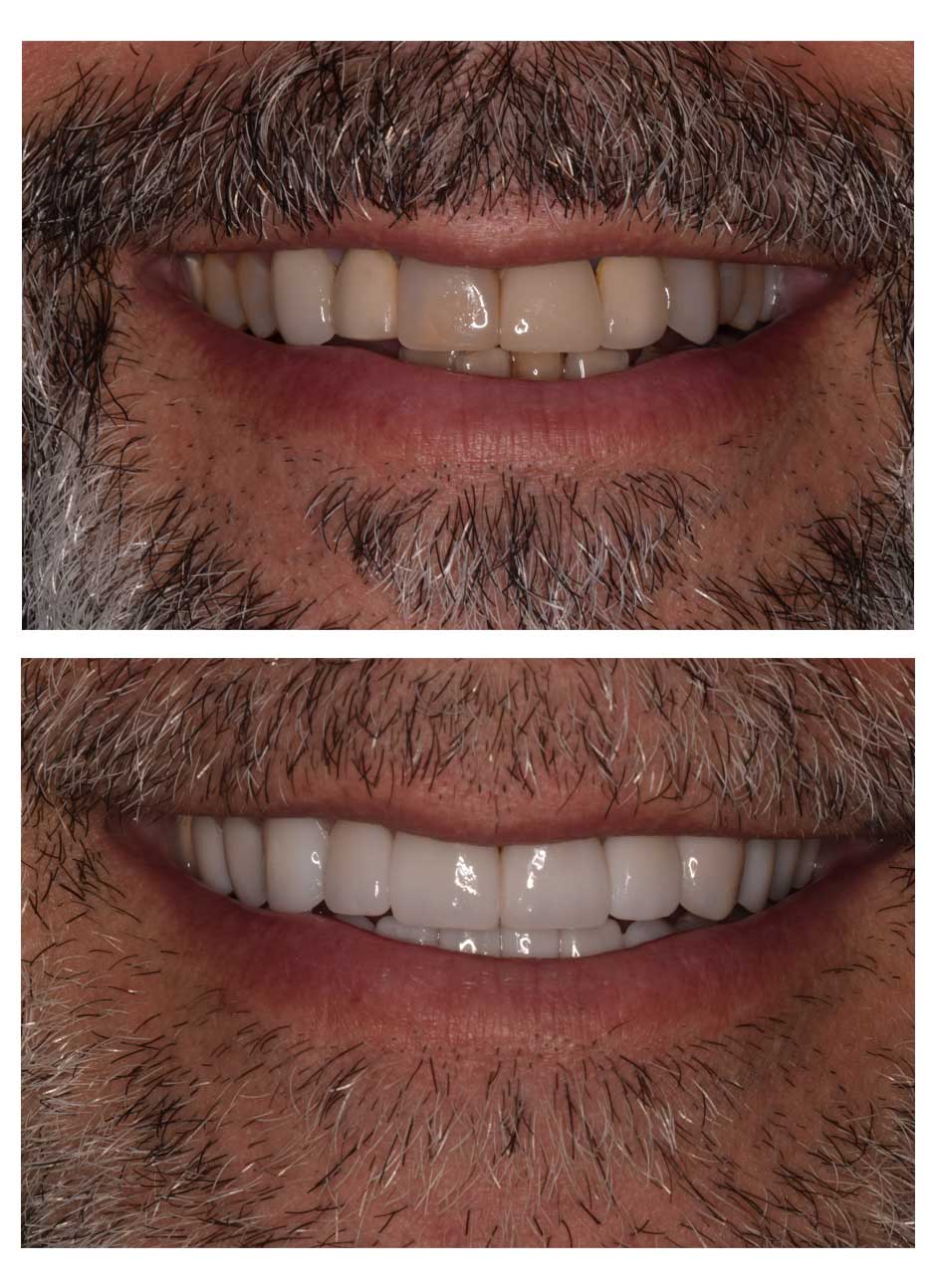 Veneers Case 8 before and after at Austin City Dental